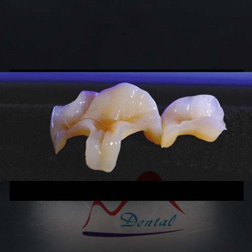 IPS E.max® inlay and onlay placed on decayed tooth