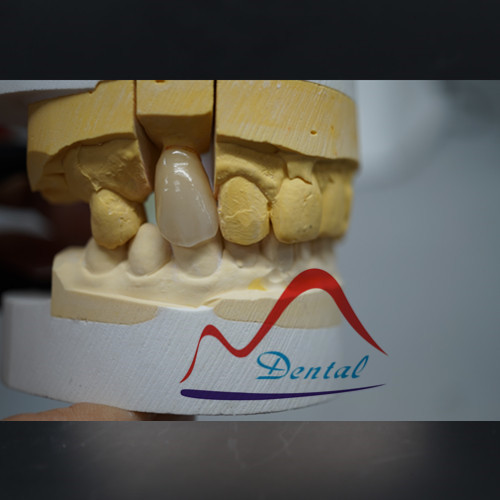 zirconia crown  (2)