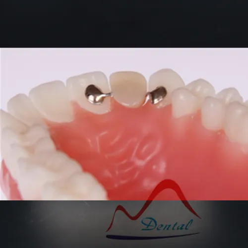 개별적으로 만든된 치과 메릴랜드 브릿지, 고품질 개별적으로 만든된 치과 메릴랜드 브릿지