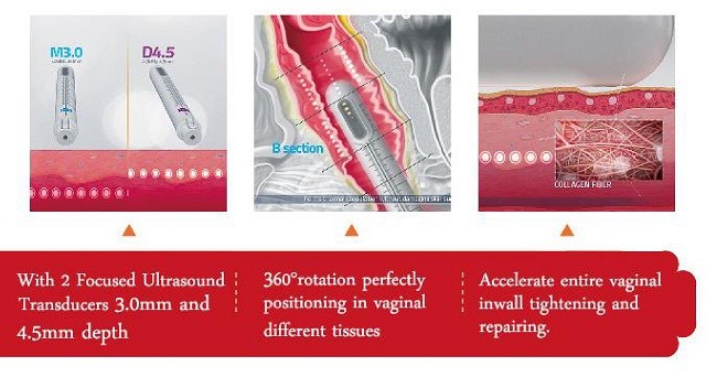 Fast Effective Beauty Salon Use Hifu Vaginal Tightening Rejuvenation Private Vagina Care Machine