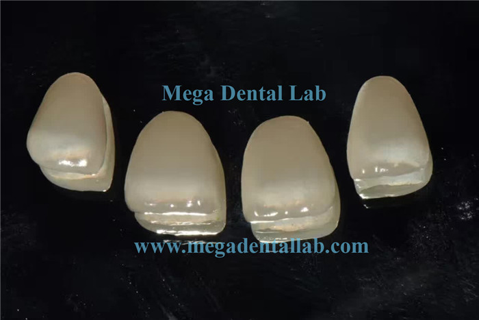 E-max supper thin veneers (1)