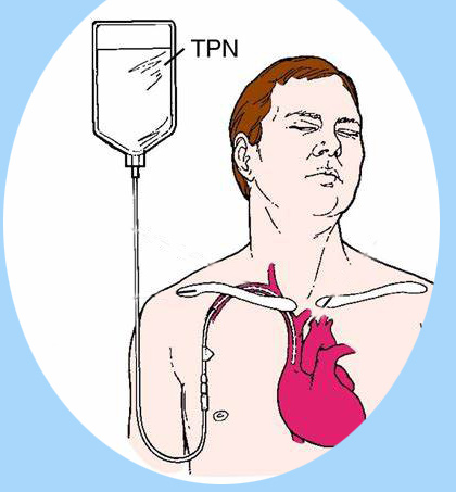 Tpn Smofkabiven 1477ml, FRESENIUS, Prescription at Rs 2800/bag in Chennai