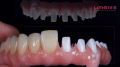 Arch Full Zirconia Malo Bridge