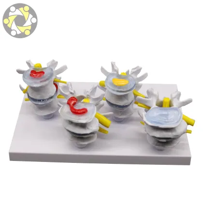 Pathological 4-Stage Human Lumbar Vertebrae Spine Disease Model
