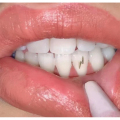 10k 22K Mini Gold Dental Zähne Edelsteine