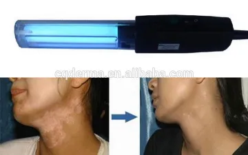 311NM NB UVB lamp for Vitiligo treatment 311nm lamp
