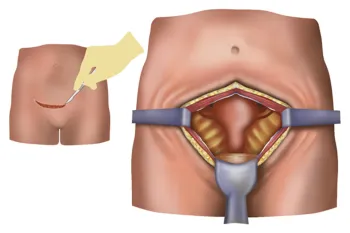 Hyaluronic Acid Pelvic surgery Anti-adhesion