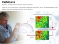 Photonbiomodulacja mózgu 810nm Hełm terapii świetlnej