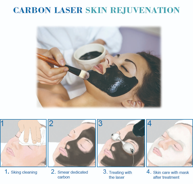 q switch laser machine