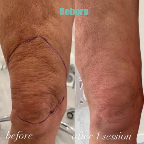 Wrinkles Removal Collagen Booster For Knees Rejuvenation