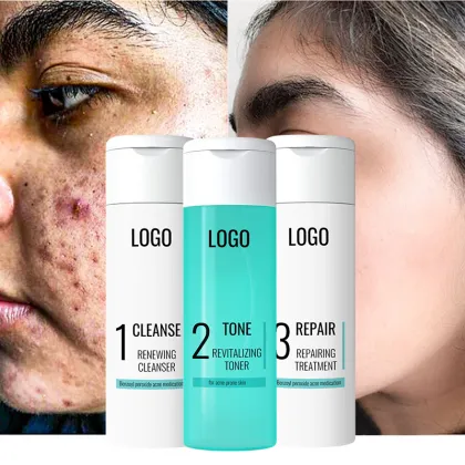 Vegan Anti-Acne Facial Care Set: Oil Control Cleanser, Moisturizer, and Toner