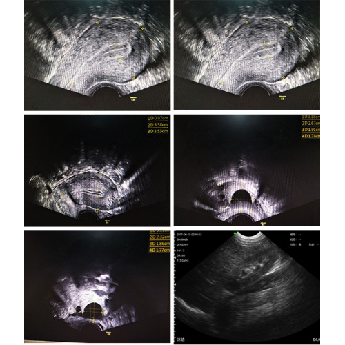 Sonda sem fio Doppler cor de intracavidade