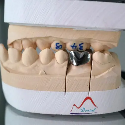 NP Full Metal Casting Crown