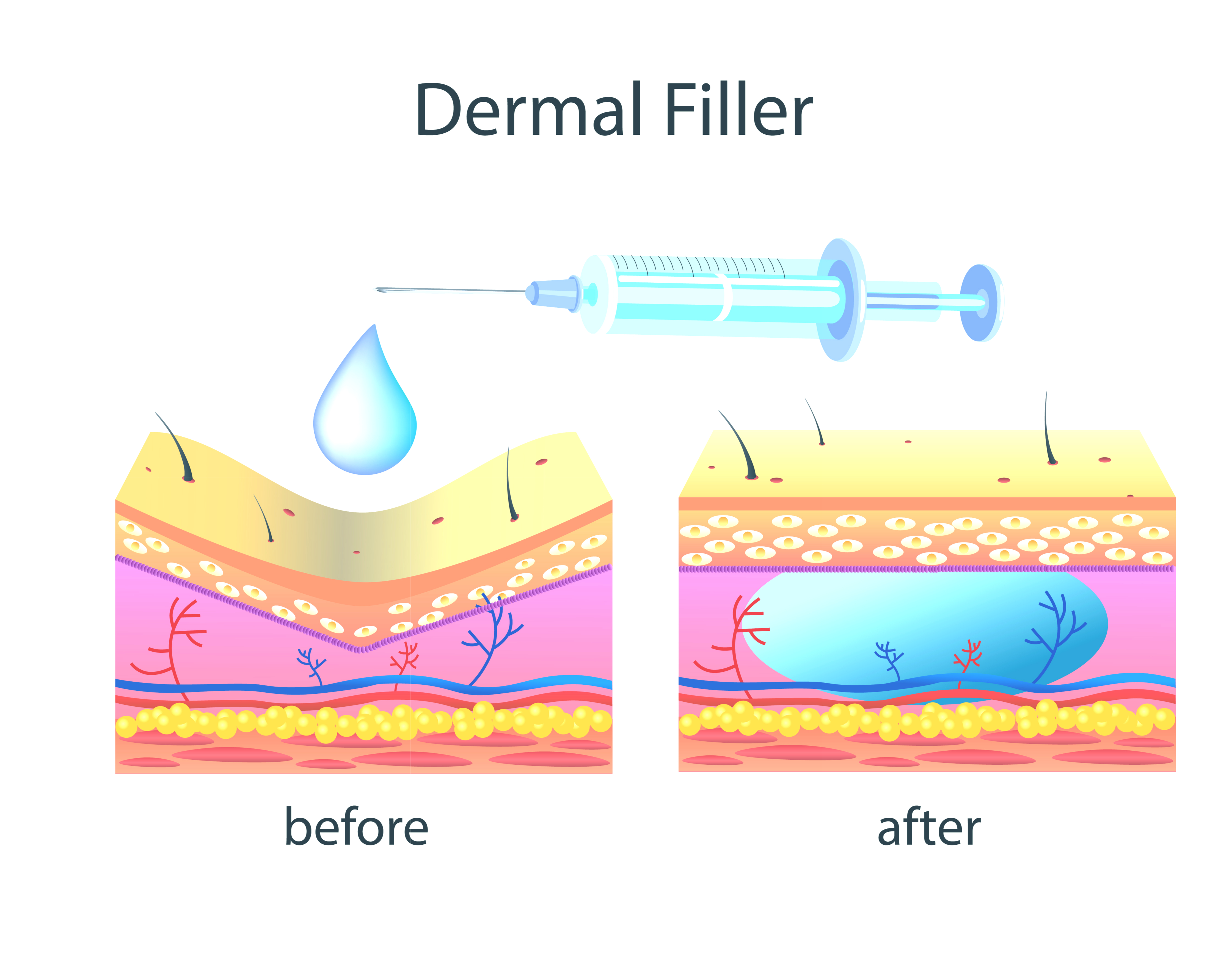 Dermal-Fillers