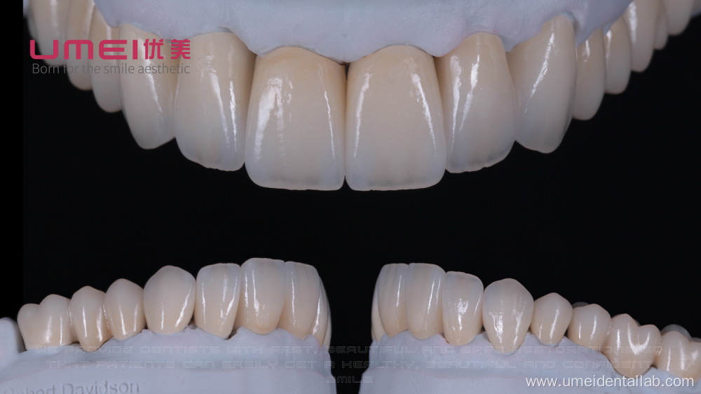 Zirconia crown