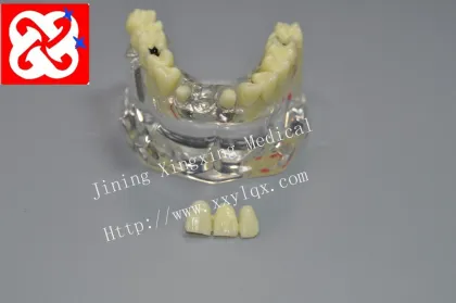 Dental Model Upper Half: Implant and Restoration