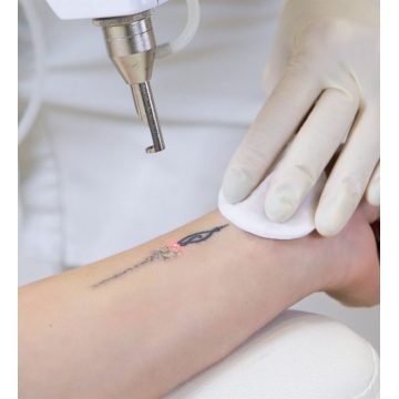 Choicy Academy Tattoo Removal Removal Tender Online