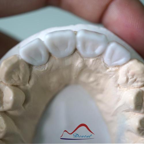Aesthetic Dental Diagnostic Wax-up