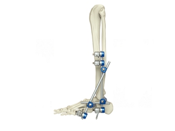 Tibial shaft external fixation Straight External Fixator