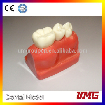 Dental Implant Model for Tooth Implant Demonstration