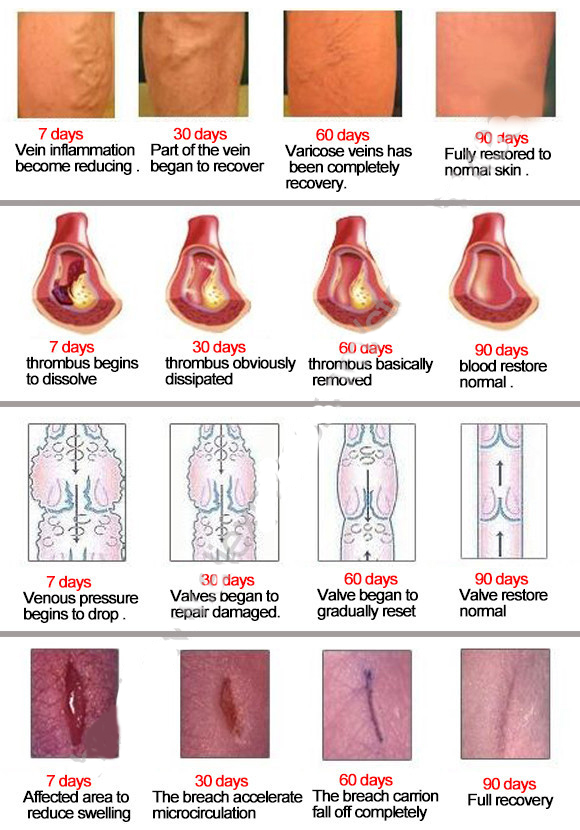10Pcs Varicose Veins ointment vasculitis treatment Phlebitis Angiitis inflammation blood vessel Rotten legs Varicose Veins Cream
