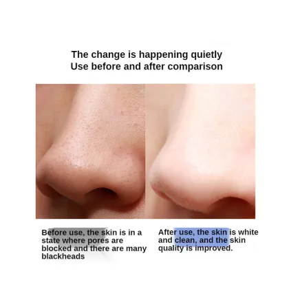 Ultrasonic Ion Exfoliator Device for Black Head Removal