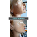 Age Restoration Dermal Filler For Under Eyes Wrinkles