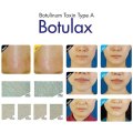 Botox cosmétique pour les rides du front du cou