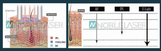 Elight beauty equipment 