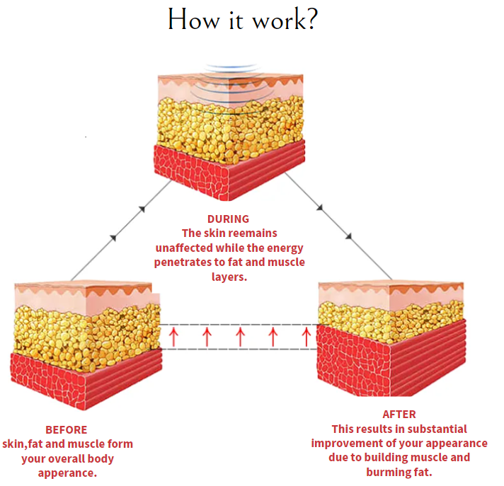 Working theory emsculpt+cryolipolyse