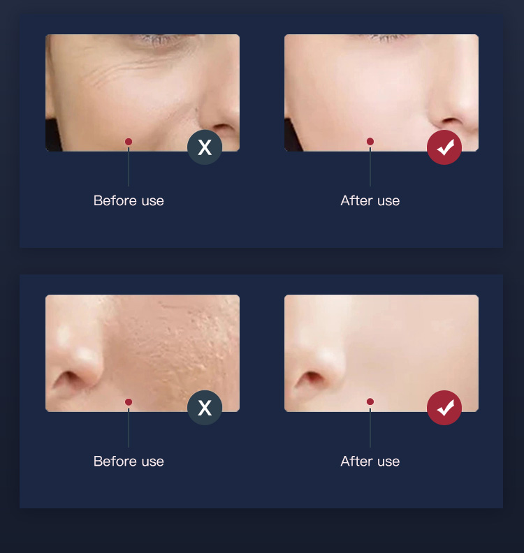 led face light therapy