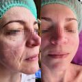 Painless Injectable Dermal Filler For Nasolabial Lines