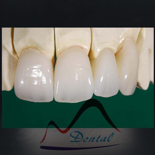 High Quality Dental IPS Emax Cosmetic Crown All Ceramics