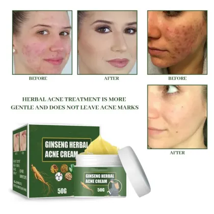 Korean Ginseng Herbal Niacinamide Anti-Acne Facial Cream