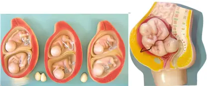 Twin pregnancy model