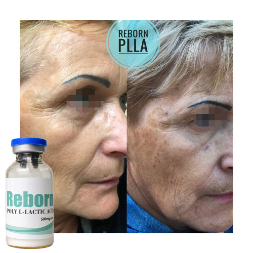 PLLA Dermal Filler para levantamento corporal