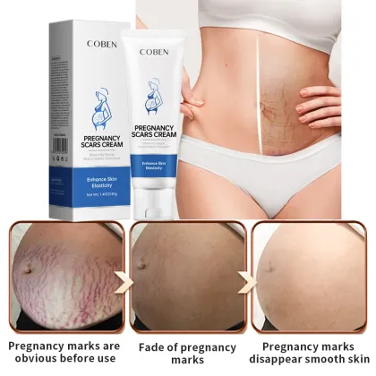 Stretch Mark and Scar Removal Cream for Women