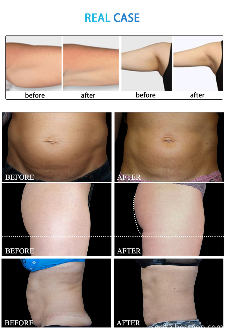 Cellulite And Fat Reduction Machine