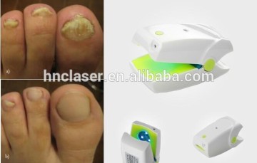 China manufacturer best selling nail fungal cure laser therapy device (onychomycosis)
