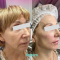 Long-last Poly L-lactic Acid Filler for Face Injection