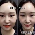 Coreia CellOfill v Cha Nel Face fina dissolve gordura facial