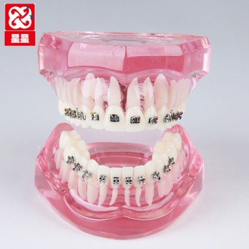 Orthodontic Demonstration Dental Model with Metal Brackets