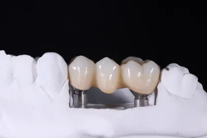 Zirconia Implant bridge