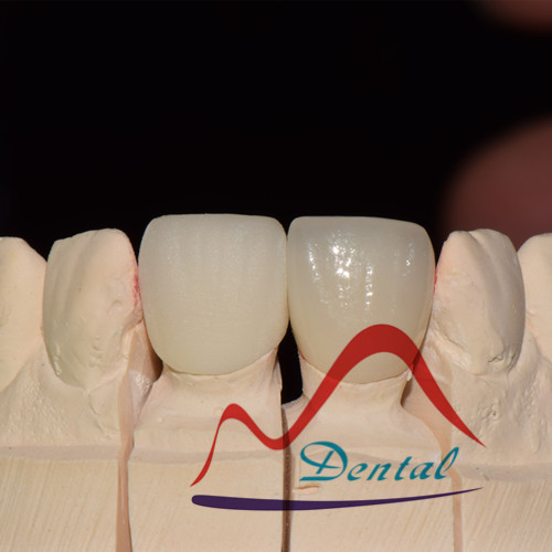 Natural Dental Zirconia Anteriors