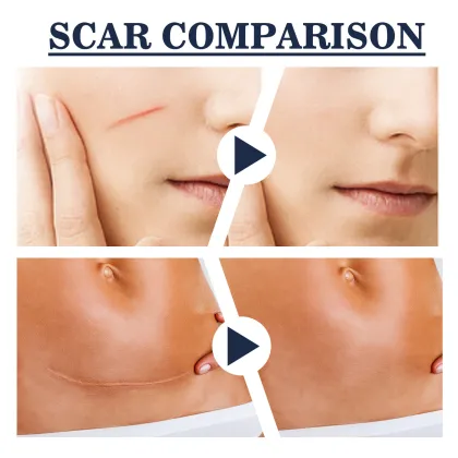 After Pregnancy Acne and Stretch Marks Repair Cream