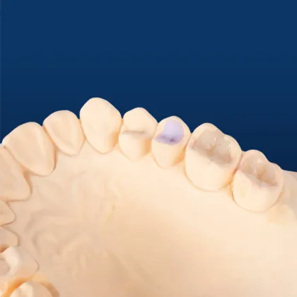 IPS Emax Dental Restorations