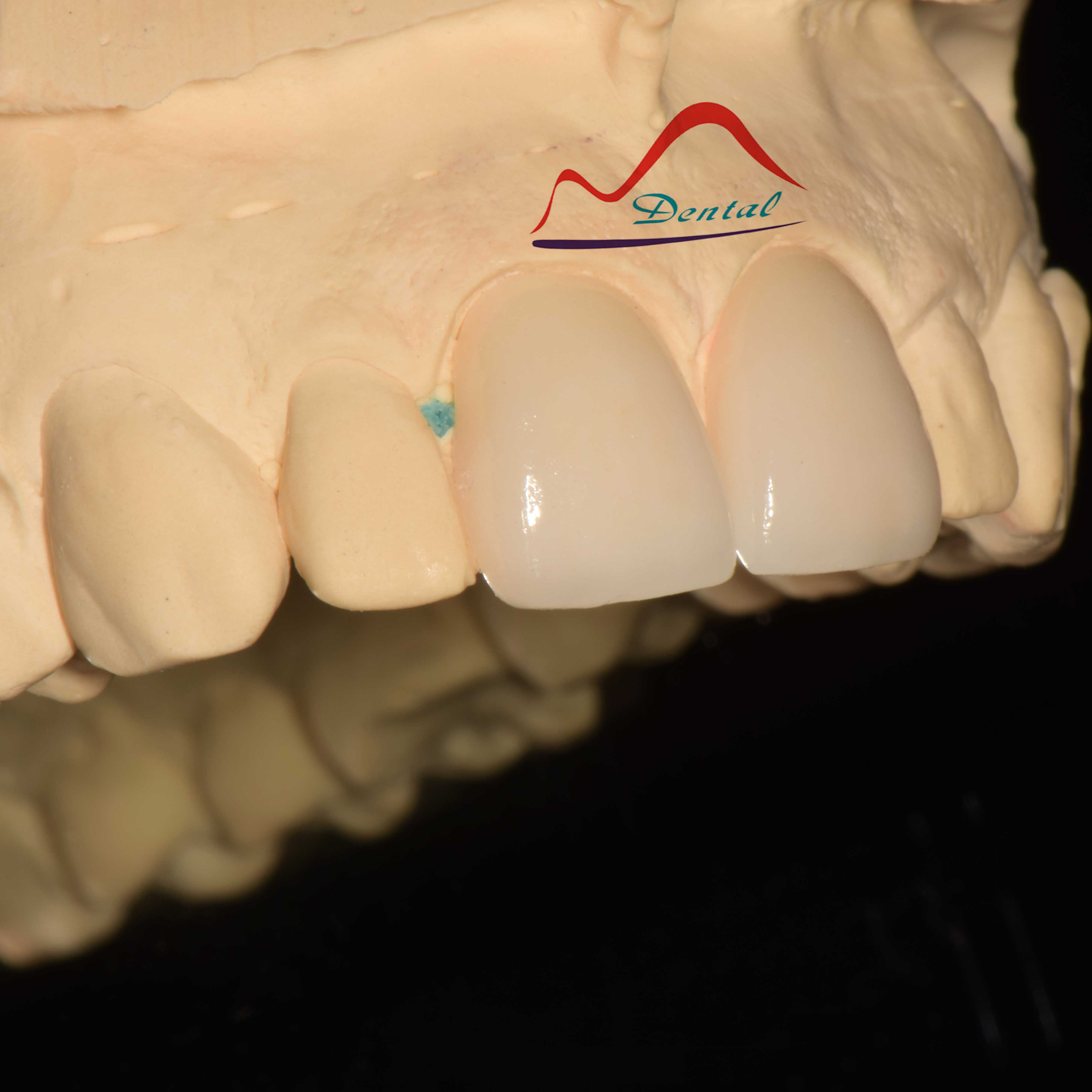 Dental Aesthetic Porcelain Veneers d