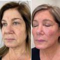 Facial Lifting Fili Fish Prsee Cog PDO Thread