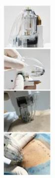 2017 best selling Skin reguvenation device for clinic use