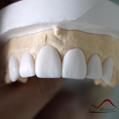 Dental Diagnostic Wax Up